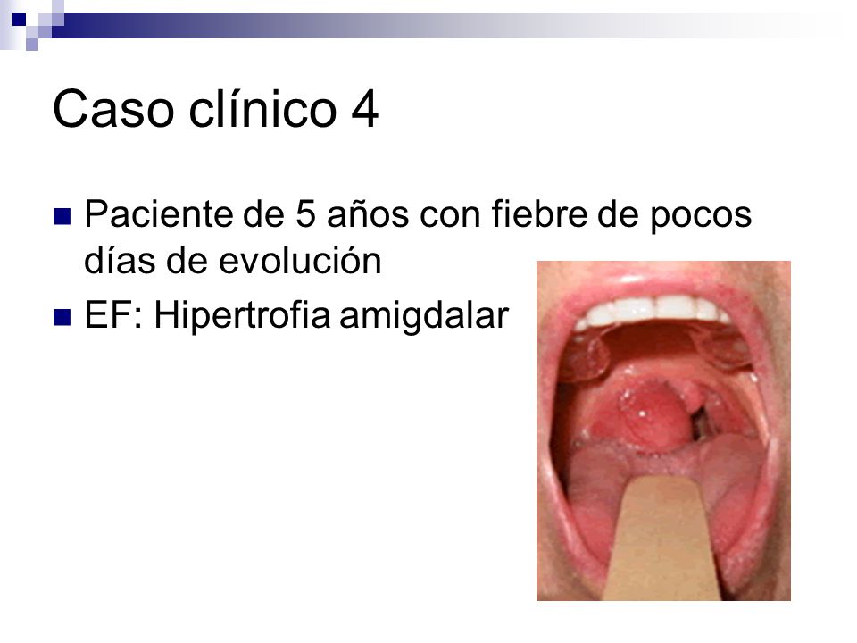 Caso clínico 4 Paciente de 5 años con fiebre de pocos días de evolución EF: Hipertrofia amigdalar