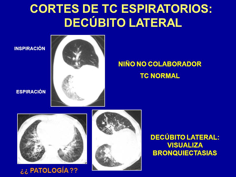 CORTES DE TC ESPIRATORIOS: DECÚBITO LATERAL: VISUALIZA BRONQUIECTASIAS