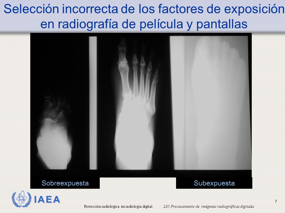 Selección incorrecta de los factores de exposición en radiografía de película y pantallas