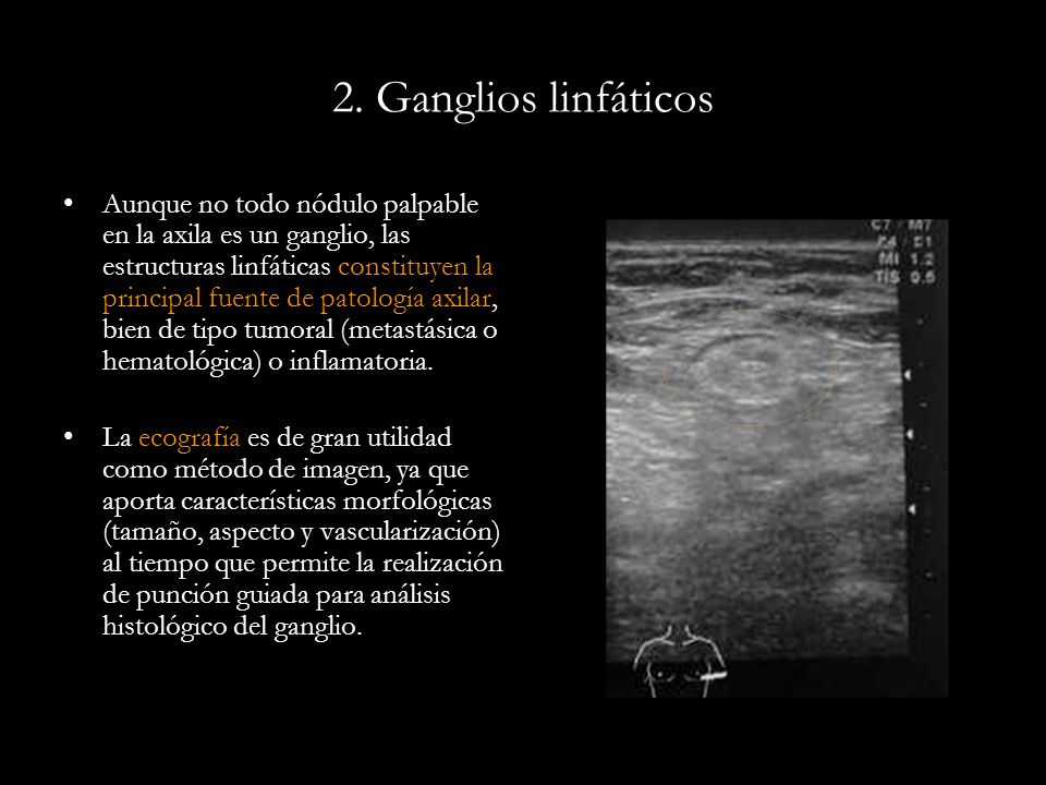 2. Ganglios linfáticos