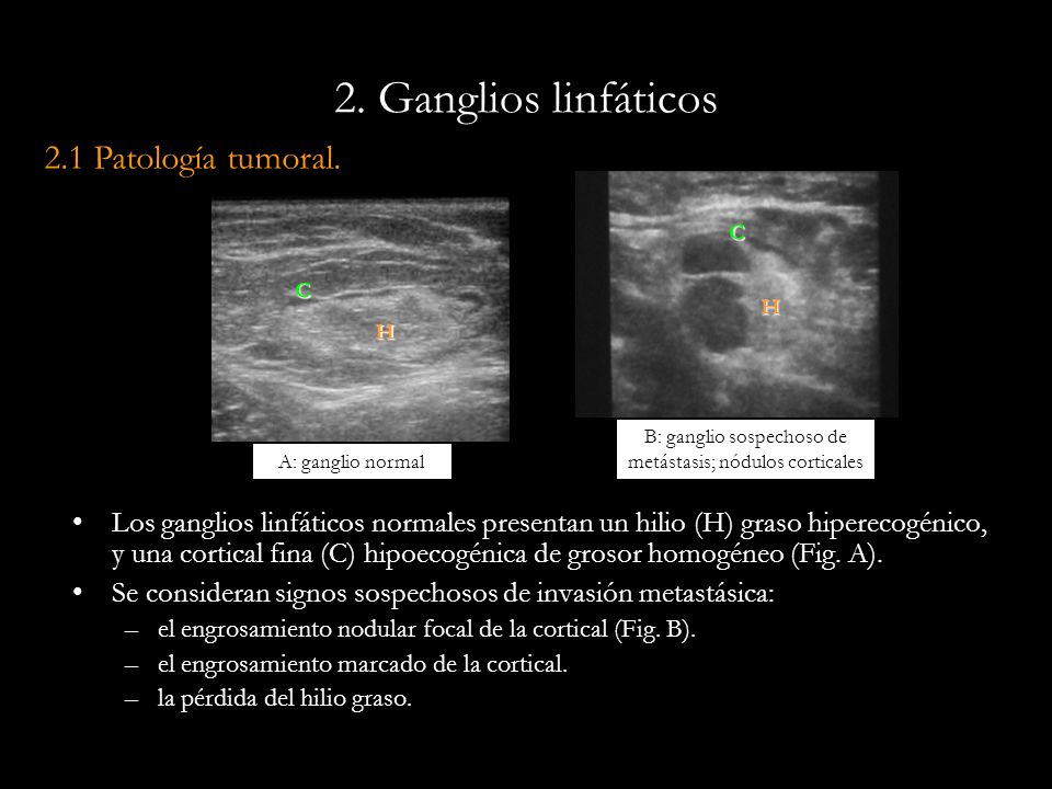 B: ganglio sospechoso de metástasis; nódulos corticales