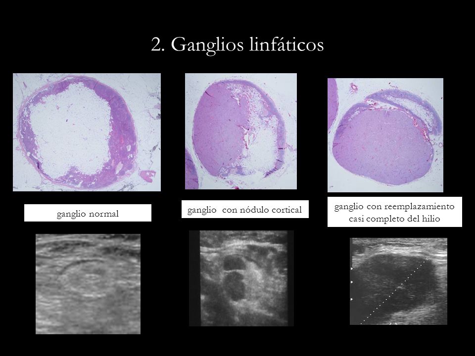 2. Ganglios linfáticos ganglio con reemplazamiento casi completo del hilio. ganglio con nódulo cortical.