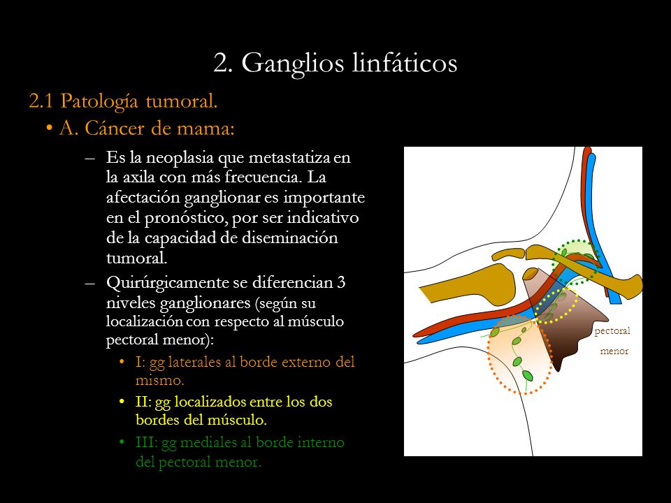2. Ganglios linfáticos 2.1 Patología tumoral. A. Cáncer de mama: