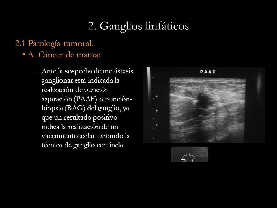 2. Ganglios linfáticos 2.1 Patología tumoral. A. Cáncer de mama: