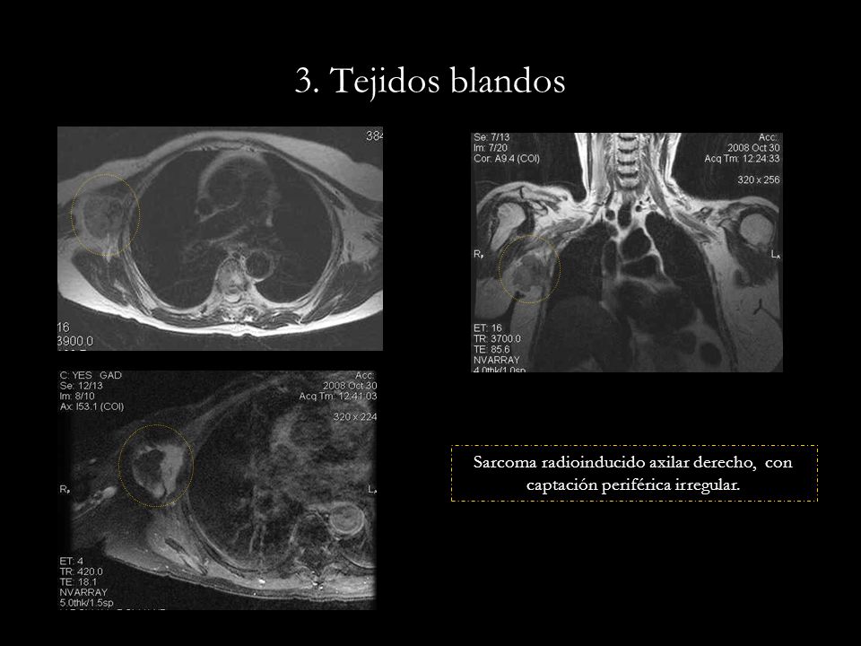 3. Tejidos blandos Sarcoma radioinducido axilar derecho, con captación periférica irregular.