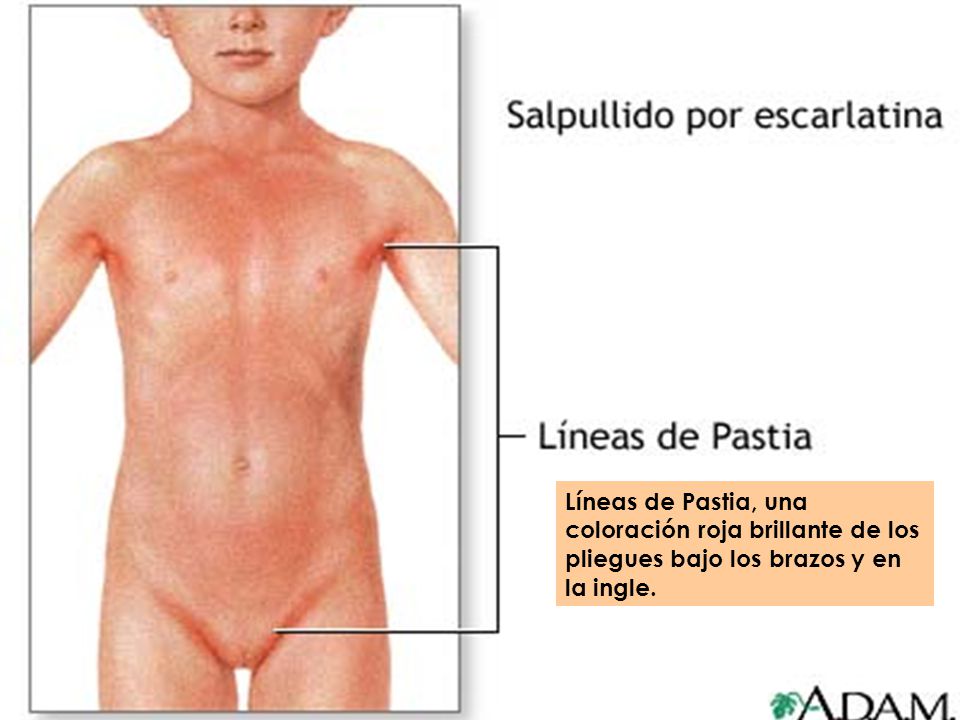 Líneas de Pastia, una coloración roja brillante de los pliegues bajo los brazos y en la ingle.