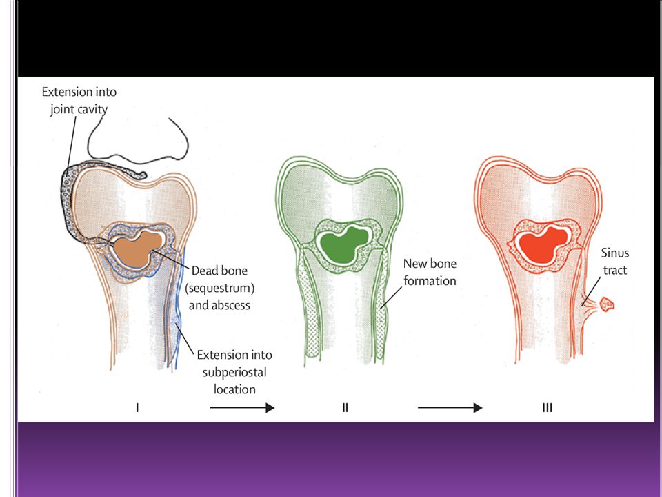 La presencia de tejido óseo desvitalizado, especialmente si además existe un cuerpo extraño (por ejemplo, una prótesis me-tálica) favorece la adhesividad bacteriana, lo que tiene un papel primordial en la cronificación de la infección.