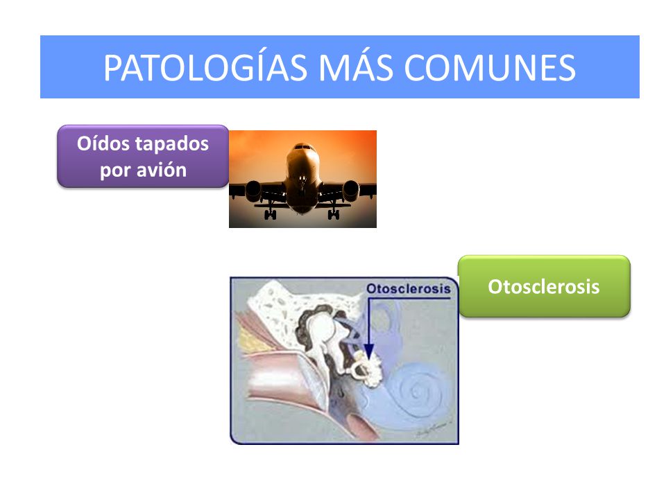 Oídos tapados por avión