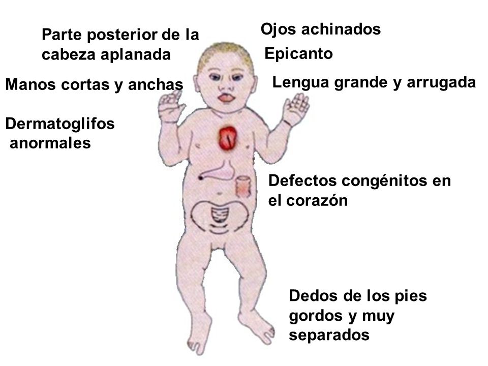 Ojos achinados Parte posterior de la. cabeza aplanada. Epicanto. Manos cortas y anchas. Dermatoglifos.