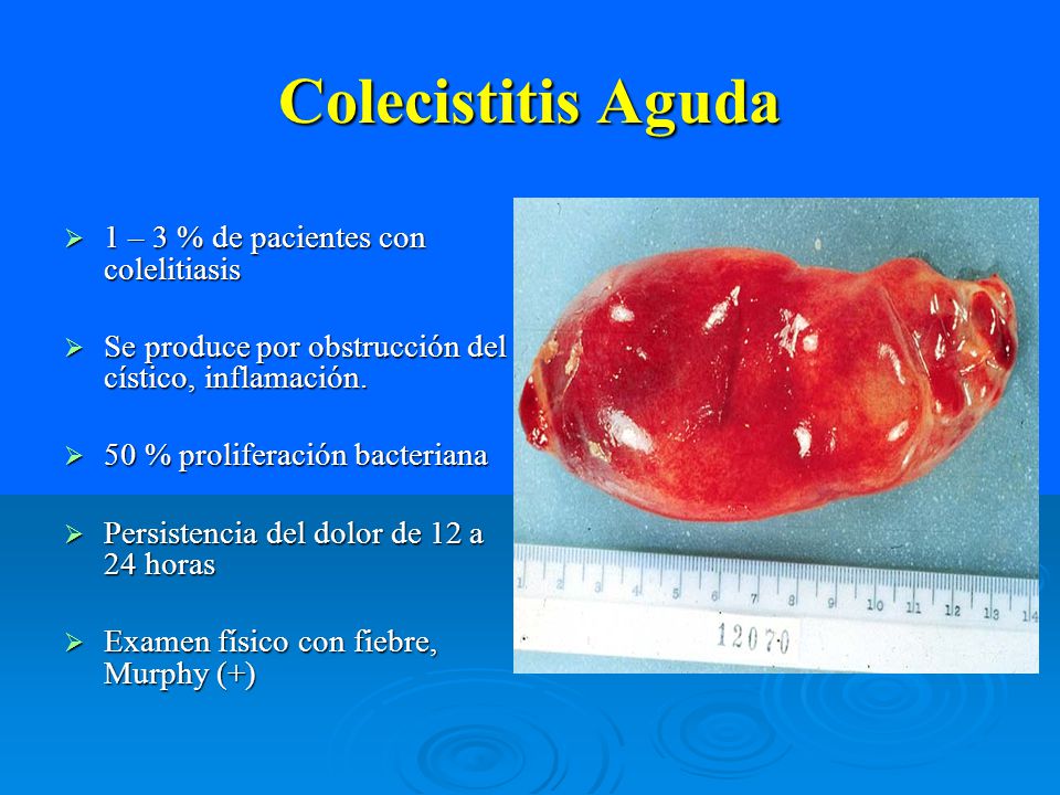 Colecistitis Aguda 1 – 3 % de pacientes con colelitiasis