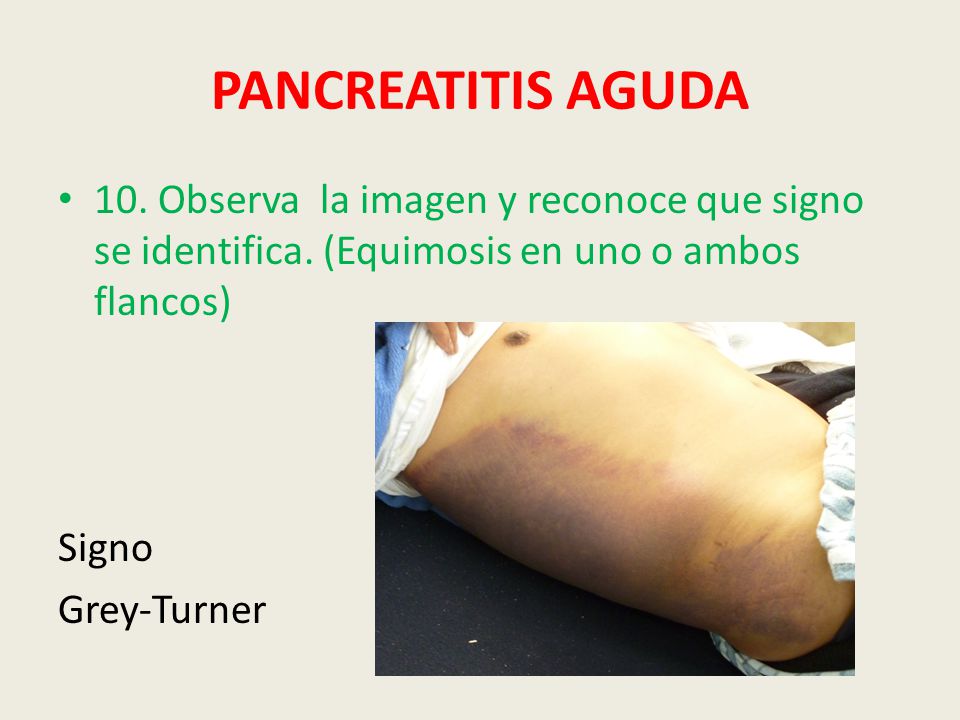 PANCREATITIS AGUDA 10. Observa la imagen y reconoce que signo se identifica. (Equimosis en uno o ambos flancos)