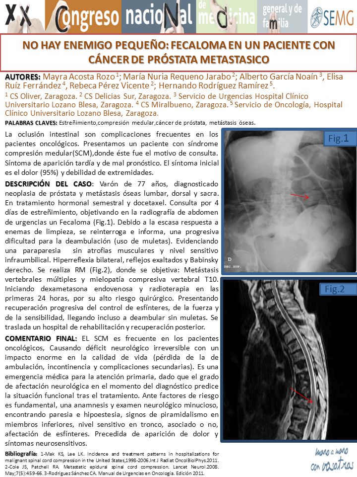 NO HAY ENEMIGO PEQUEÑO: FECALOMA EN UN PACIENTE CON CÁNCER DE PRÓSTATA METASTASICO