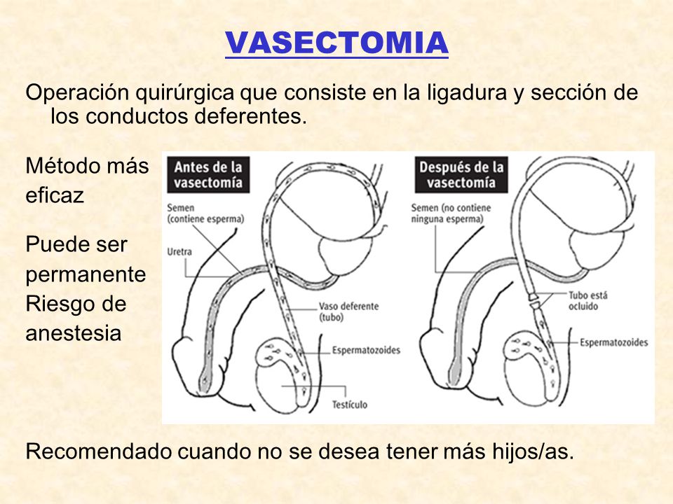 VASECTOMIA Operación quirúrgica que consiste en la ligadura y sección de los conductos deferentes. Método más.