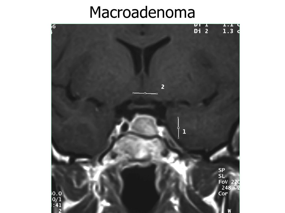 Macroadenoma