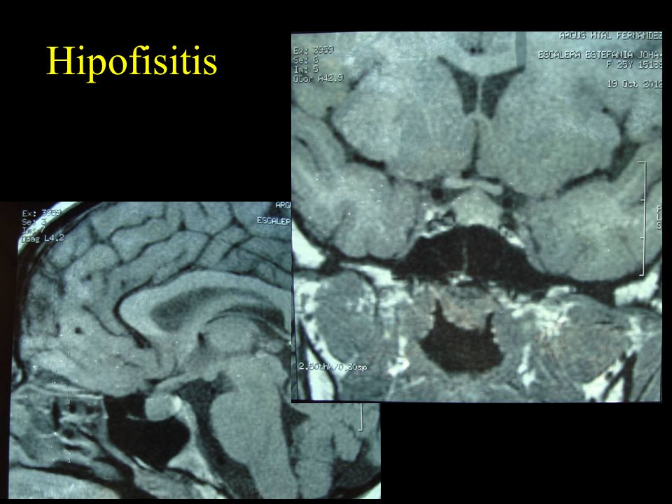 Hipofisitis