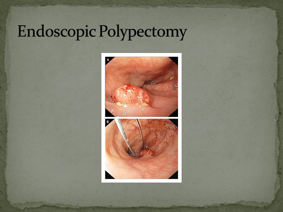 Endoscopic Polypectomy