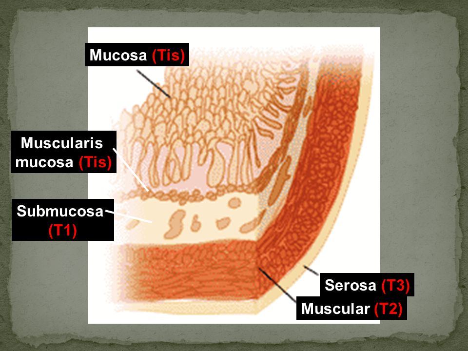 Mucosa (Tis) Muscularis mucosa (Tis) Submucosa (T1) Serosa (T3) Muscular (T2)