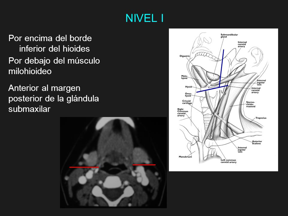 NIVEL I Por encima del borde inferior del hioides