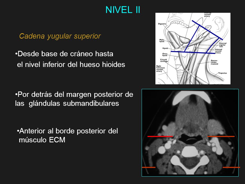 NIVEL II Cadena yugular superior Desde base de cráneo hasta