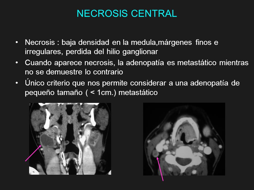 NECROSIS CENTRAL Necrosis : baja densidad en la medula,márgenes finos e irregulares, perdida del hilio ganglionar.