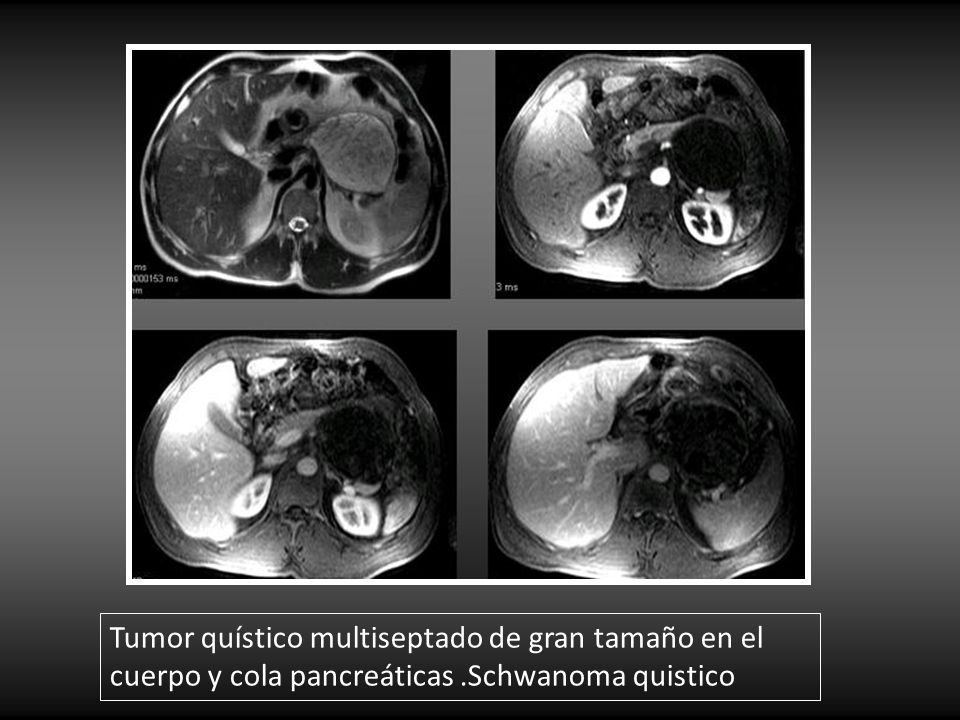 Tumor quístico multiseptado de gran tamaño en el cuerpo y cola pancreáticas .Schwanoma quistico