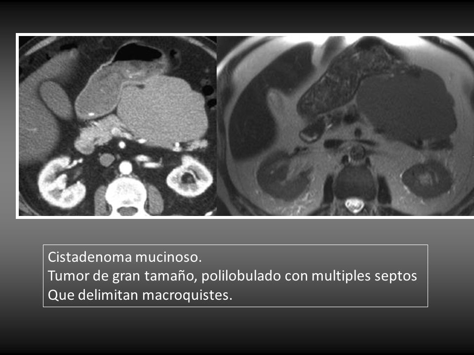 Cistadenoma mucinoso. Tumor de gran tamaño, polilobulado con multiples septos.