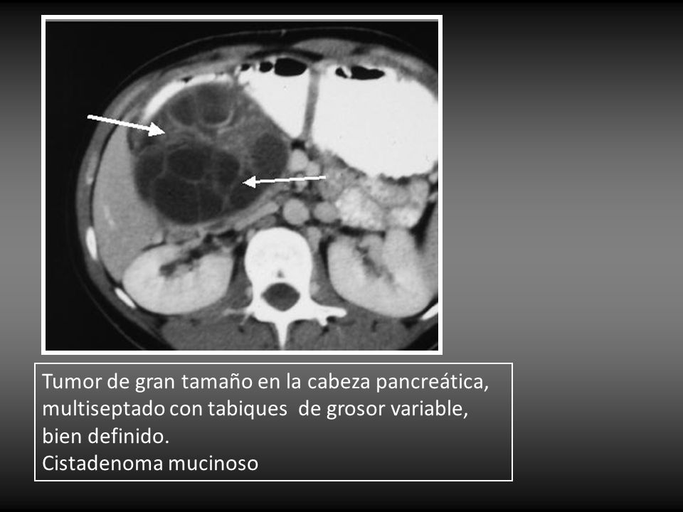 Tumor de gran tamaño en la cabeza pancreática, multiseptado con tabiques de grosor variable, bien definido.