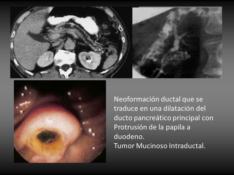 Neoformación ductal que se traduce en una dilatación del ducto pancreático principal con