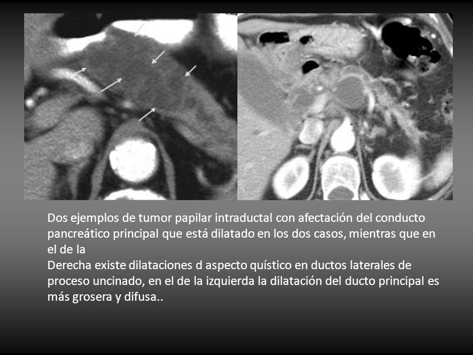 Dos ejemplos de tumor papilar intraductal con afectación del conducto pancreático principal que está dilatado en los dos casos, mientras que en el de la