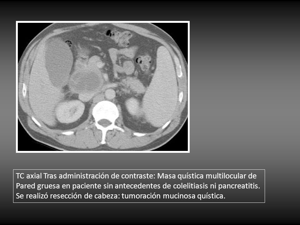 TC axial Tras administración de contraste: Masa quística multilocular de