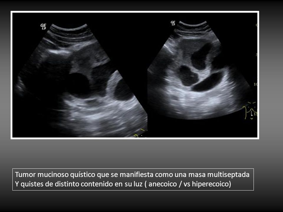 Tumor mucinoso quístico que se manifiesta como una masa multiseptada
