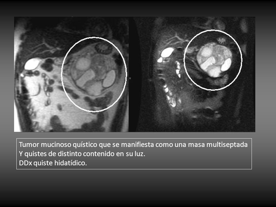 Tumor mucinoso quístico que se manifiesta como una masa multiseptada