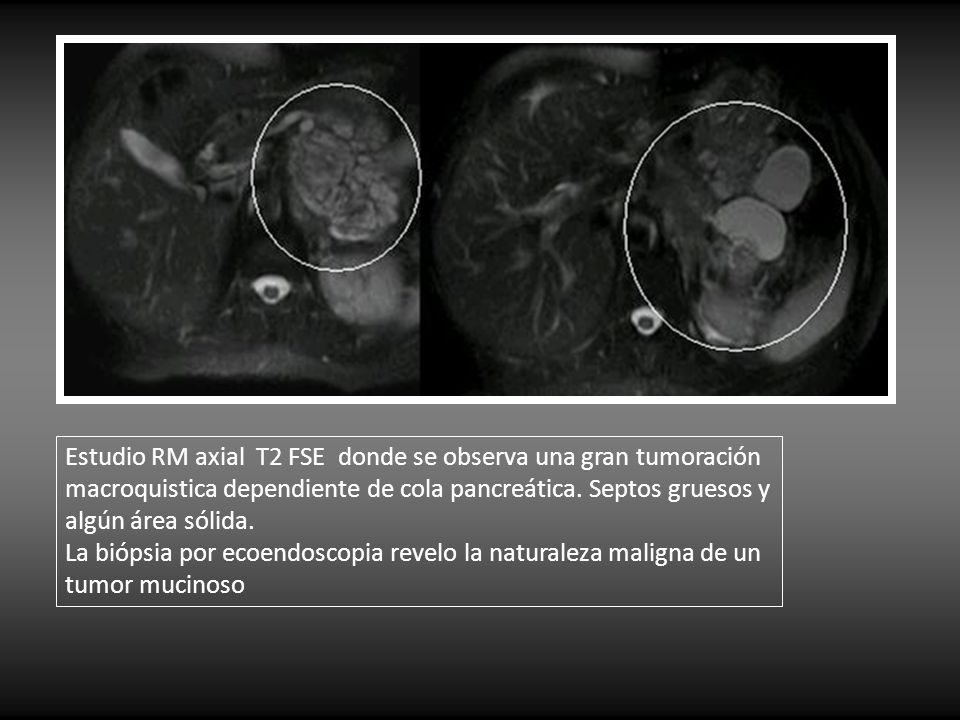 Estudio RM axial T2 FSE donde se observa una gran tumoración macroquistica dependiente de cola pancreática. Septos gruesos y algún área sólida.