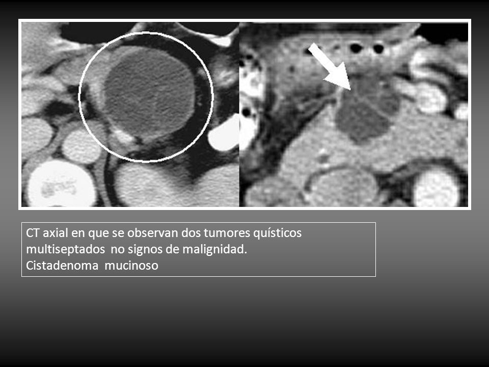 CT axial en que se observan dos tumores quísticos multiseptados no signos de malignidad.