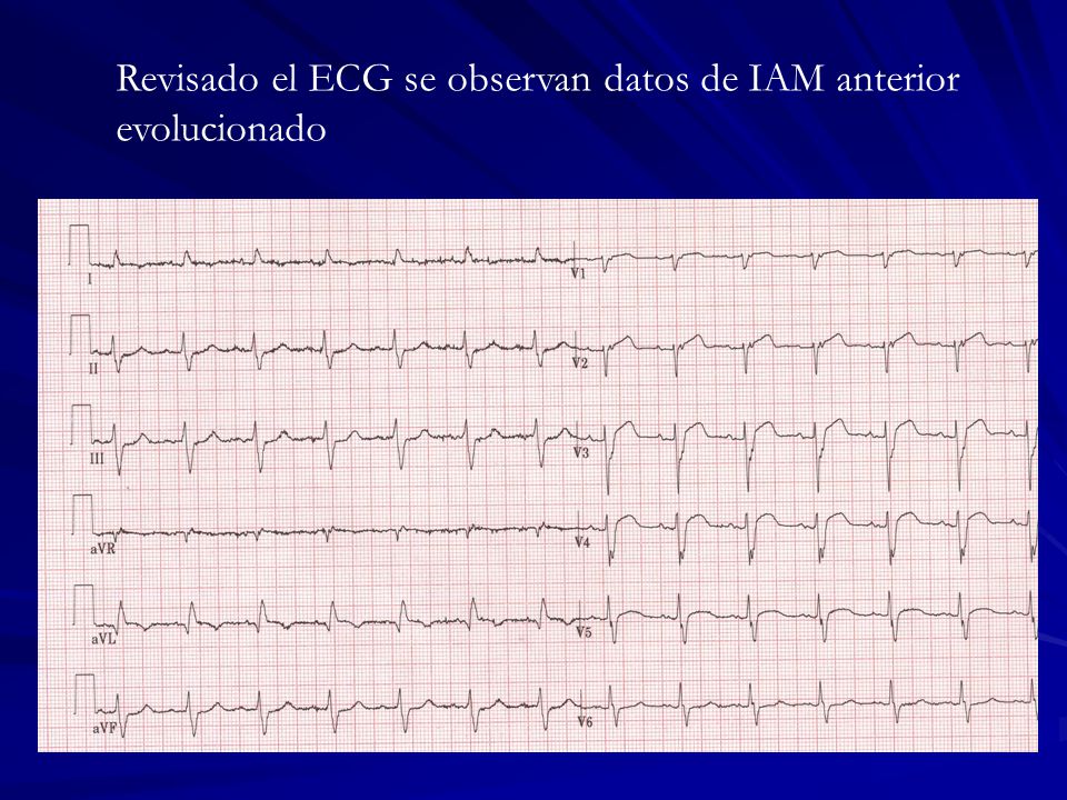 Revisado el ECG se observan datos de IAM anterior evolucionado