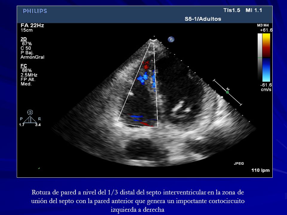 Rotura de pared a nivel del 1/3 distal del septo interventricular en la zona de unión del septo con la pared anterior que genera un importante cortocircuito izquierda a derecha