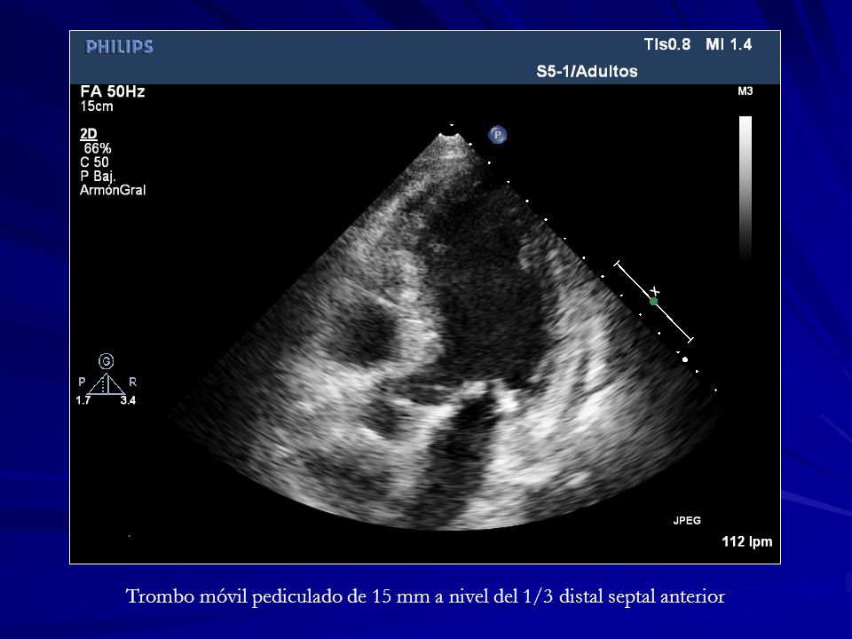 Trombo móvil pediculado de 15 mm a nivel del 1/3 distal septal anterior
