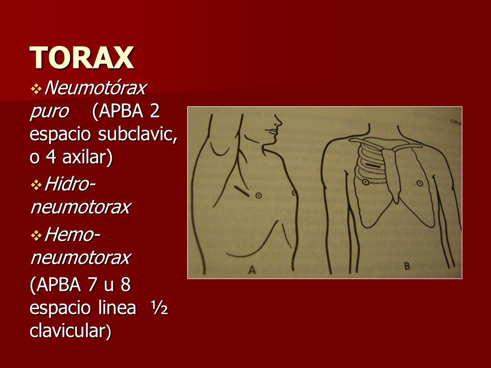 TORAX Neumotórax puro (APBA 2 espacio subclavic, o 4 axilar)