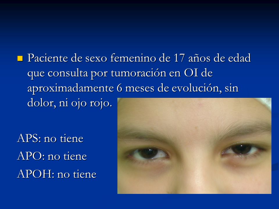 Paciente de sexo femenino de 17 años de edad que consulta por tumoración en OI de aproximadamente 6 meses de evolución, sin dolor, ni ojo rojo.