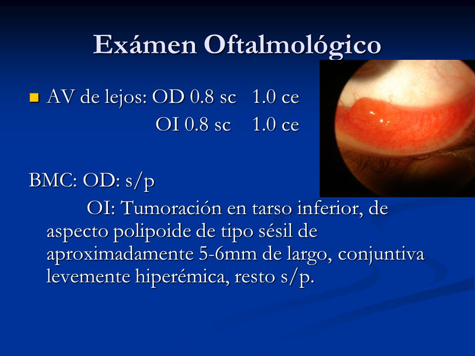 Exámen Oftalmológico AV de lejos: OD 0.8 sc 1.0 ce OI 0.8 sc 1.0 ce
