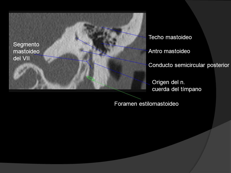 Techo mastoideo Antro mastoideo. Conducto semicircular posterior. Segmento. mastoideo. del VII.