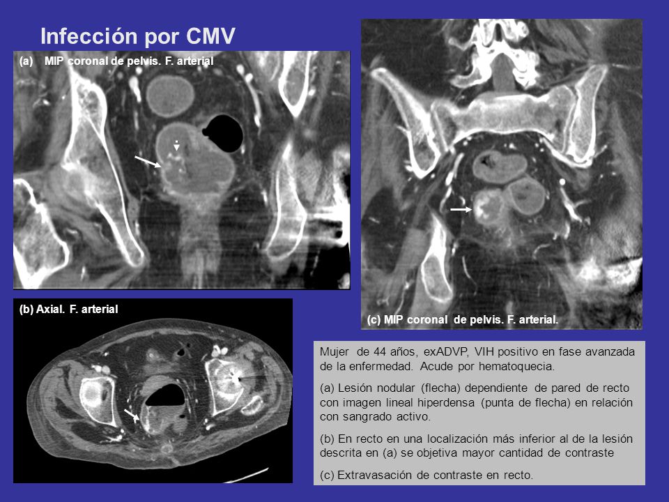 Infección por CMV MIP coronal de pelvis. F. arterial. (b) Axial. F. arterial. (c) MIP coronal de pelvis. F. arterial.