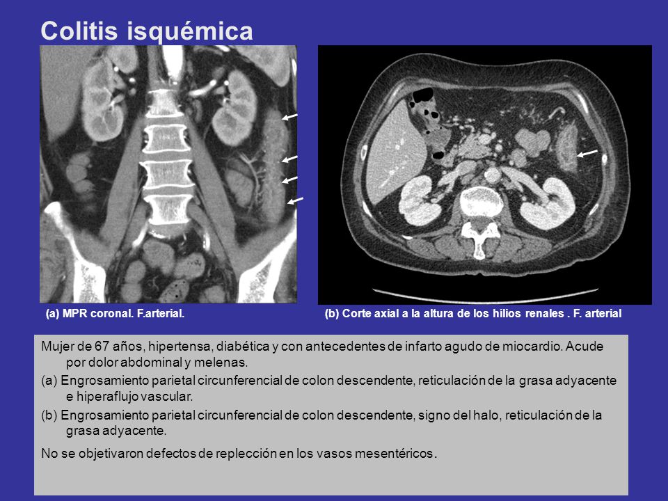 Colitis isquémica (a) MPR coronal. F.arterial. (b) Corte axial a la altura de los hílios renales . F. arterial.