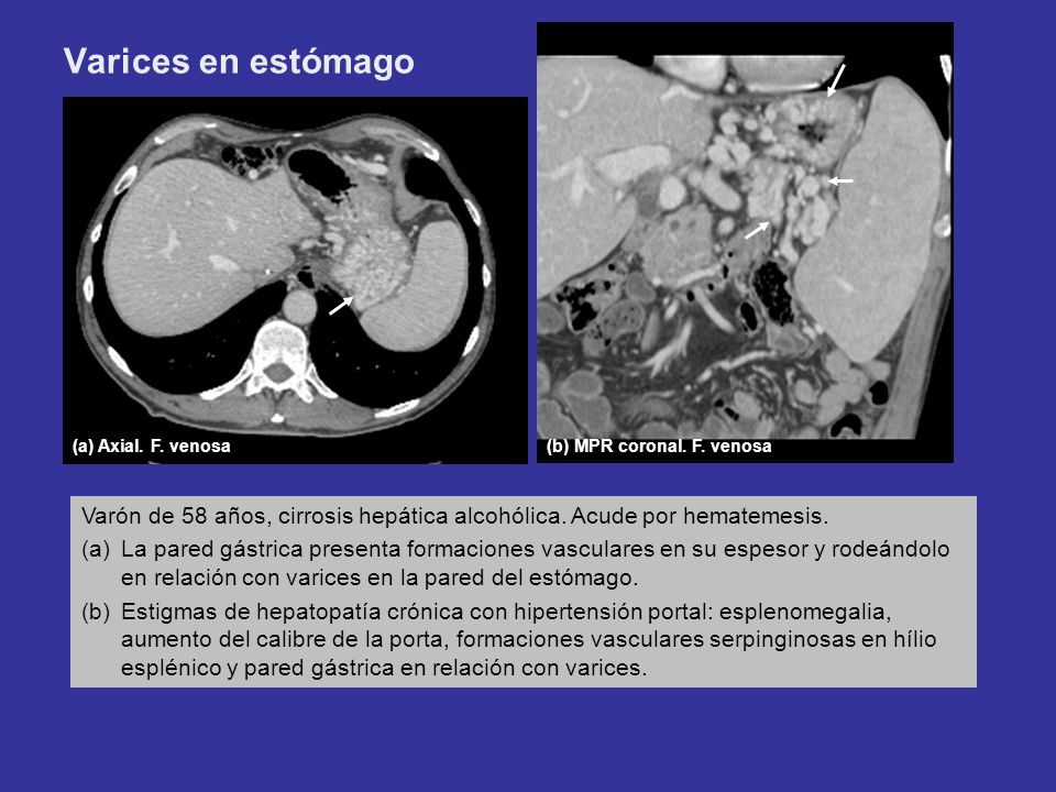 Varices en estómago (a) Axial. F. venosa. (b) MPR coronal. F. venosa. Varón de 58 años, cirrosis hepática alcohólica. Acude por hematemesis.