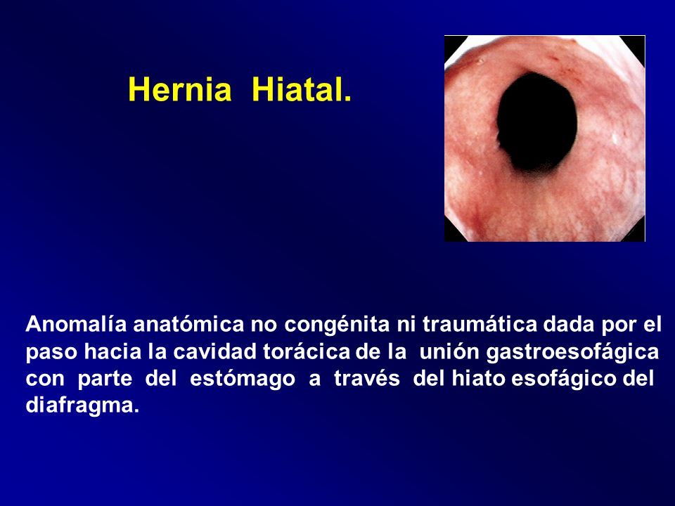 Hernia Hiatal. Anomalía anatómica no congénita ni traumática dada por el. paso hacia la cavidad torácica de la unión gastroesofágica.