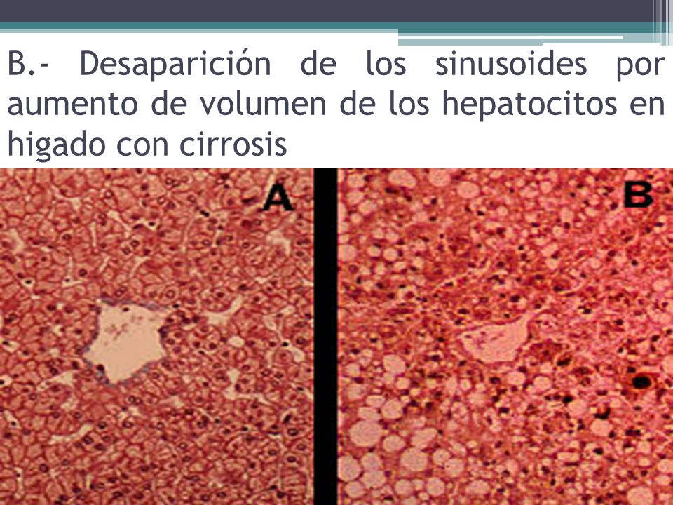 B.- Desaparición de los sinusoides por aumento de volumen de los hepatocitos en higado con cirrosis