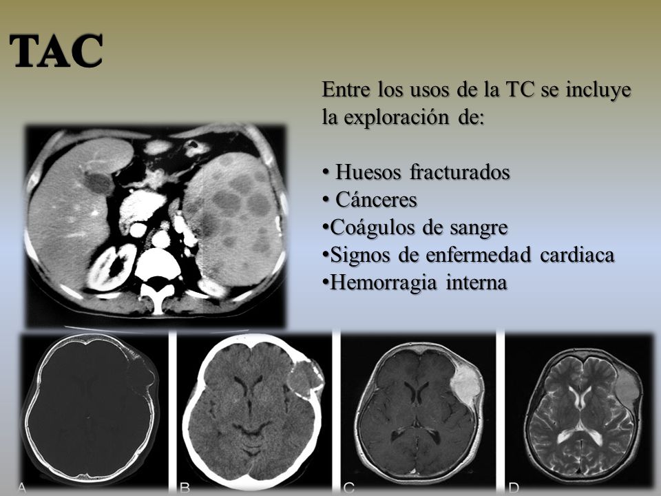TAC Entre los usos de la TC se incluye la exploración de: