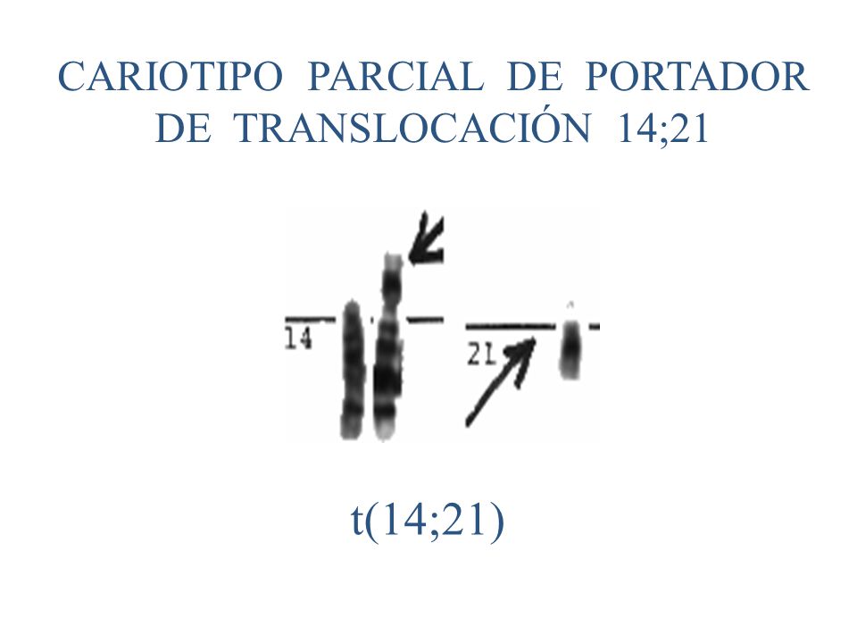 CARIOTIPO PARCIAL DE PORTADOR DE TRANSLOCACIÓN 14;21