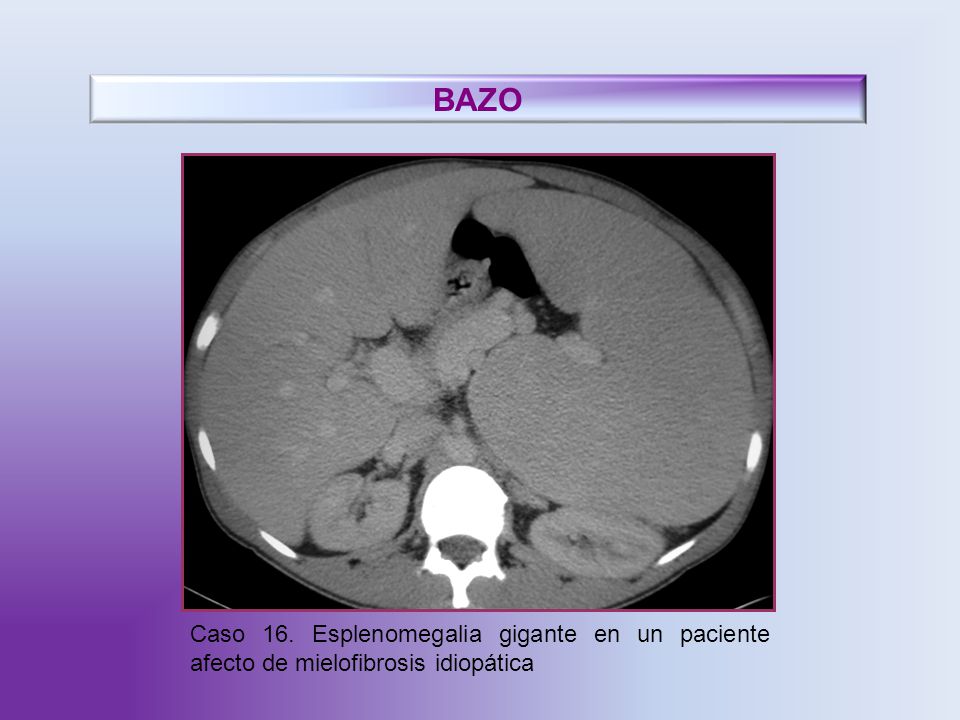 BAZO Caso 16. Esplenomegalia gigante en un paciente afecto de mielofibrosis idiopática