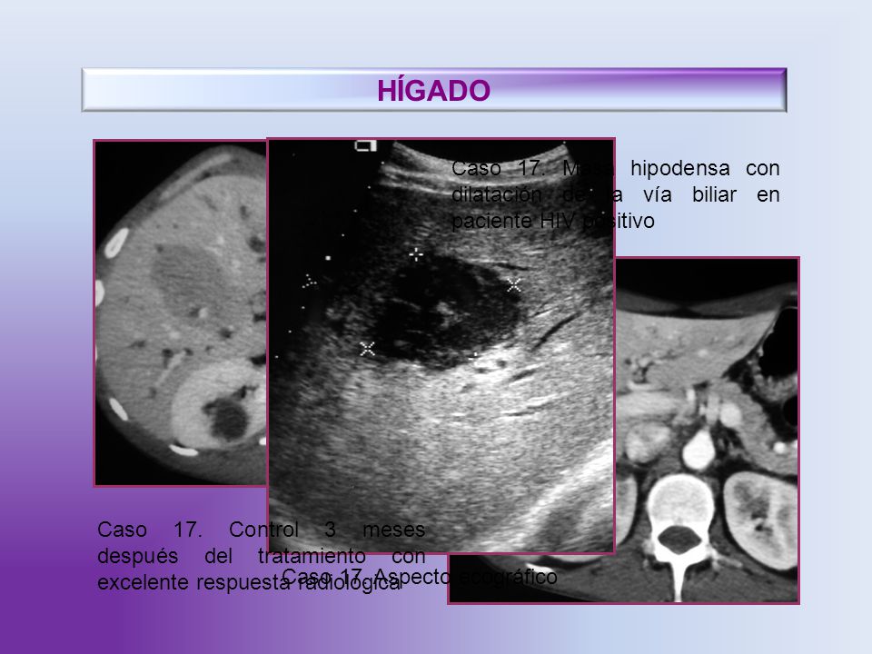 HÍGADO Caso 17. Masa hipodensa con dilatación de la vía biliar en paciente HIV positivo.